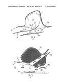 STENT WITH FLAPS diagram and image