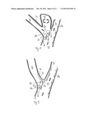 STENT WITH FLAPS diagram and image