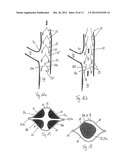 STENT WITH FLAPS diagram and image