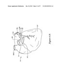 EPICARDIAL CLIP diagram and image