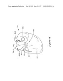 EPICARDIAL CLIP diagram and image