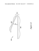 EPICARDIAL CLIP diagram and image