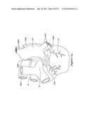 EPICARDIAL CLIP diagram and image