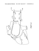 EPICARDIAL CLIP diagram and image