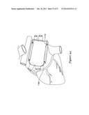 EPICARDIAL CLIP diagram and image