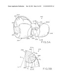 FEMORAL COMPONENT FOR A KNEE PROSTHESIS WITH IMPROVED ARTICULAR     CHARACTERISTICS diagram and image