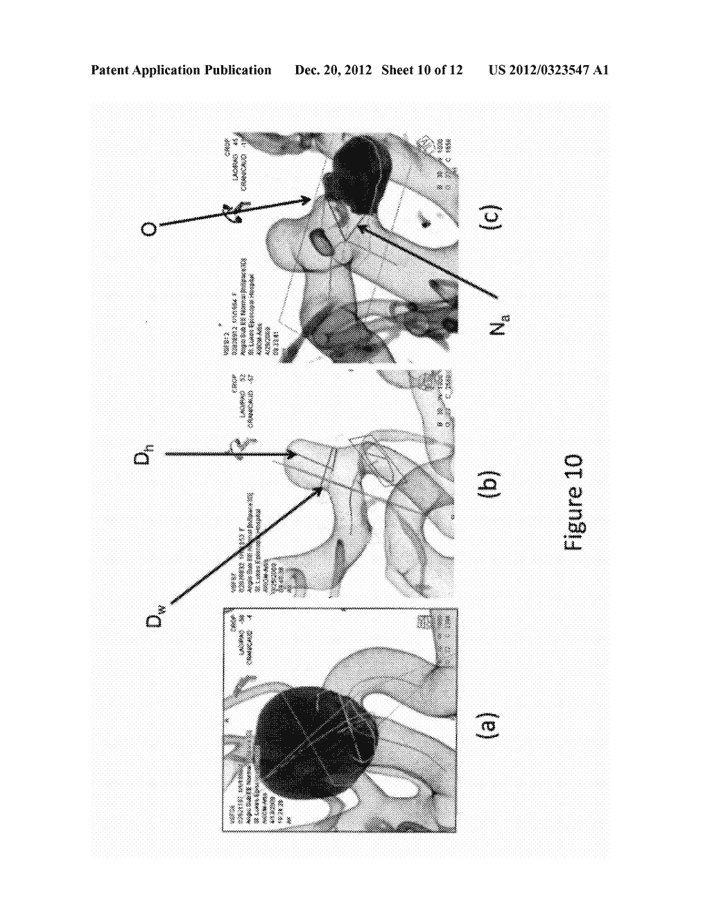 METHOD FOR INTRACRANIAL ANEURYSM ANALYSIS AND ENDOVASCULAR INTERVENTION     PLANNING - diagram, schematic, and image 11