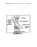 INJECTION OF FIBRIN SEALANT USING RECONSTITUTED COMPONENTS IN SPINAL     APPLICATIONS diagram and image