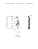 High density fibrous polymers suitable for implant diagram and image