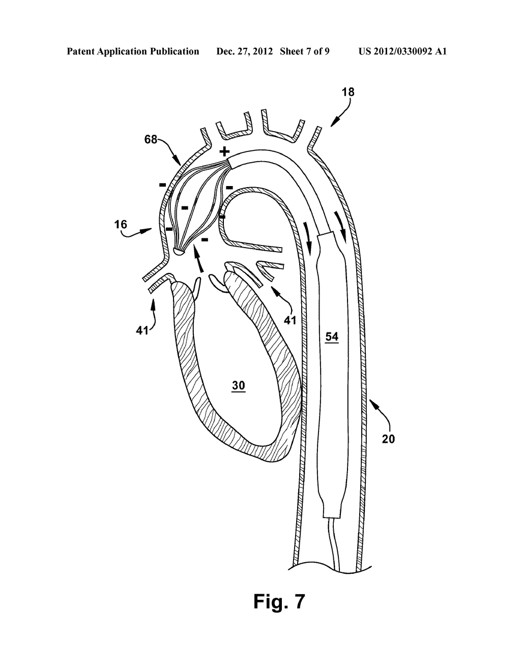 DEVICE, SYSTEM, AND METHOD FOR MODULATING CARDIAC FUNCTION - diagram, schematic, and image 08