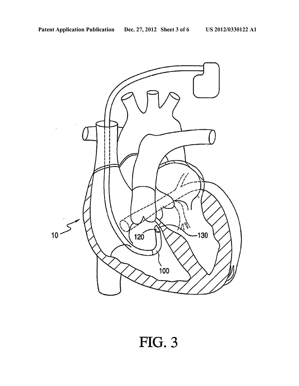 Cardiac Lead for Epicardial, Endocardial and Trans-Coronary Sinus     Placement - diagram, schematic, and image 04