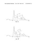 SYSTEMS AND METHODS FOR QUANIFYING AND PROVIDING INDICIA OF ST-SEGMENT     RESOLUTION IN AN ECG SIGNAL diagram and image