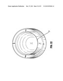 Therapeutic Cushioning and Devices for Assisting Respiration of and     administering fluid to a patient diagram and image