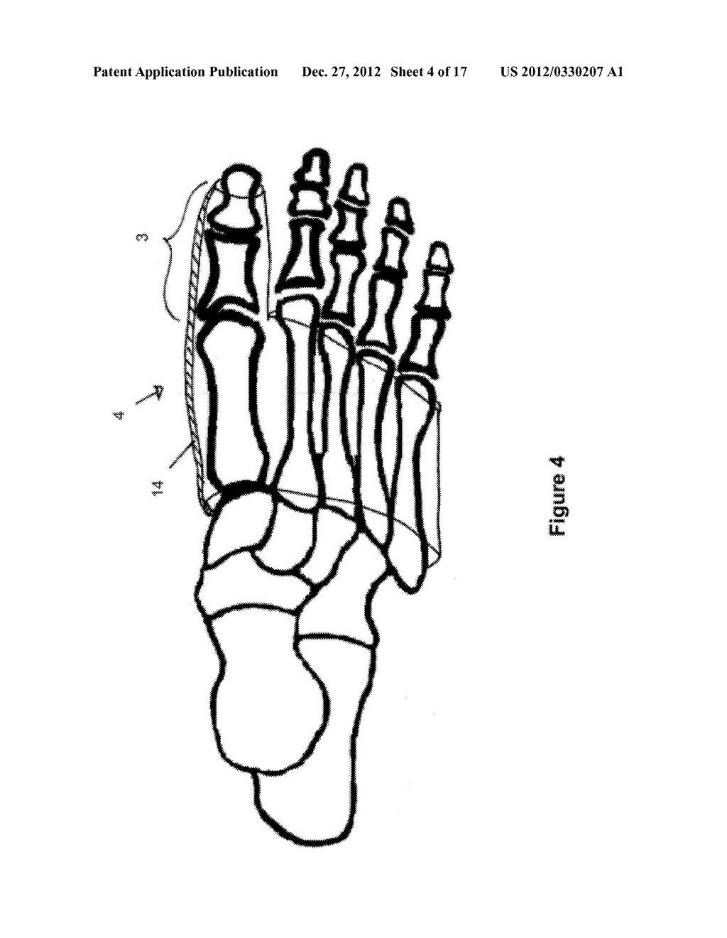 TOE BRACE DESIGNS - diagram, schematic, and image 05