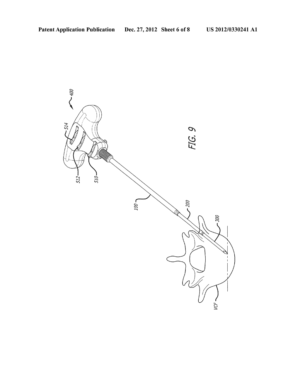 METHOD FOR USING RETRACTABLE STYLET AND CANNULA COMBINATION TO FORM AN     OPENING IN BONE - diagram, schematic, and image 07