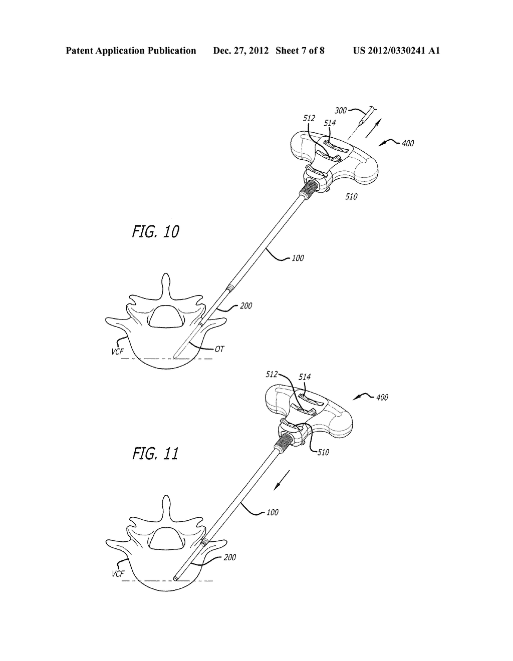 METHOD FOR USING RETRACTABLE STYLET AND CANNULA COMBINATION TO FORM AN     OPENING IN BONE - diagram, schematic, and image 08