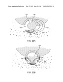 TISSUE EXTRACTION DEVICES AND METHODS diagram and image