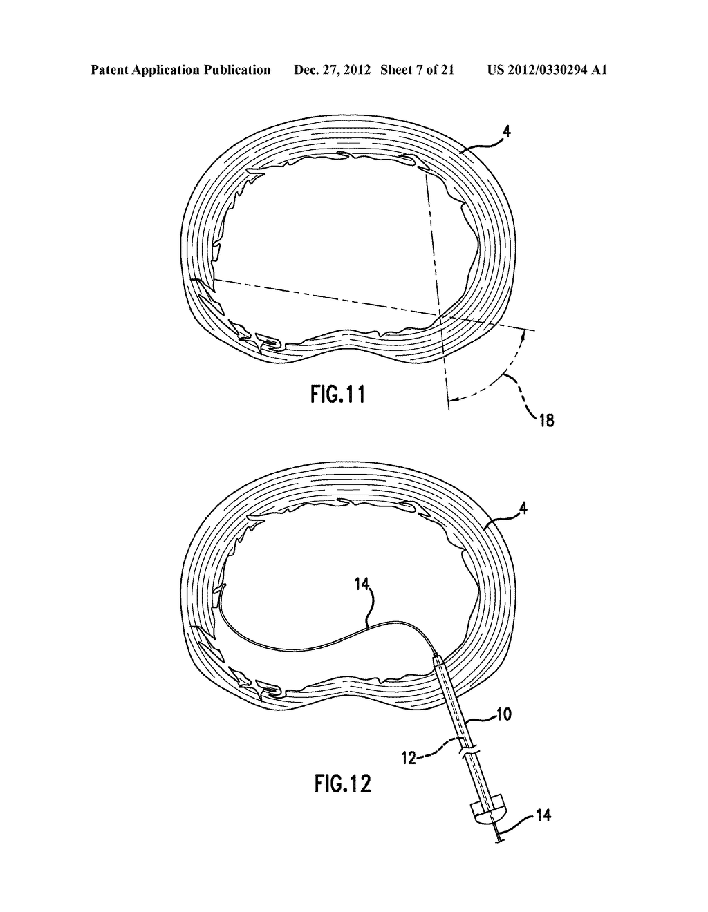 METHOD FOR TREATMENT OR EVACUATION OF INTERVERTEBRAL DISC - diagram, schematic, and image 08