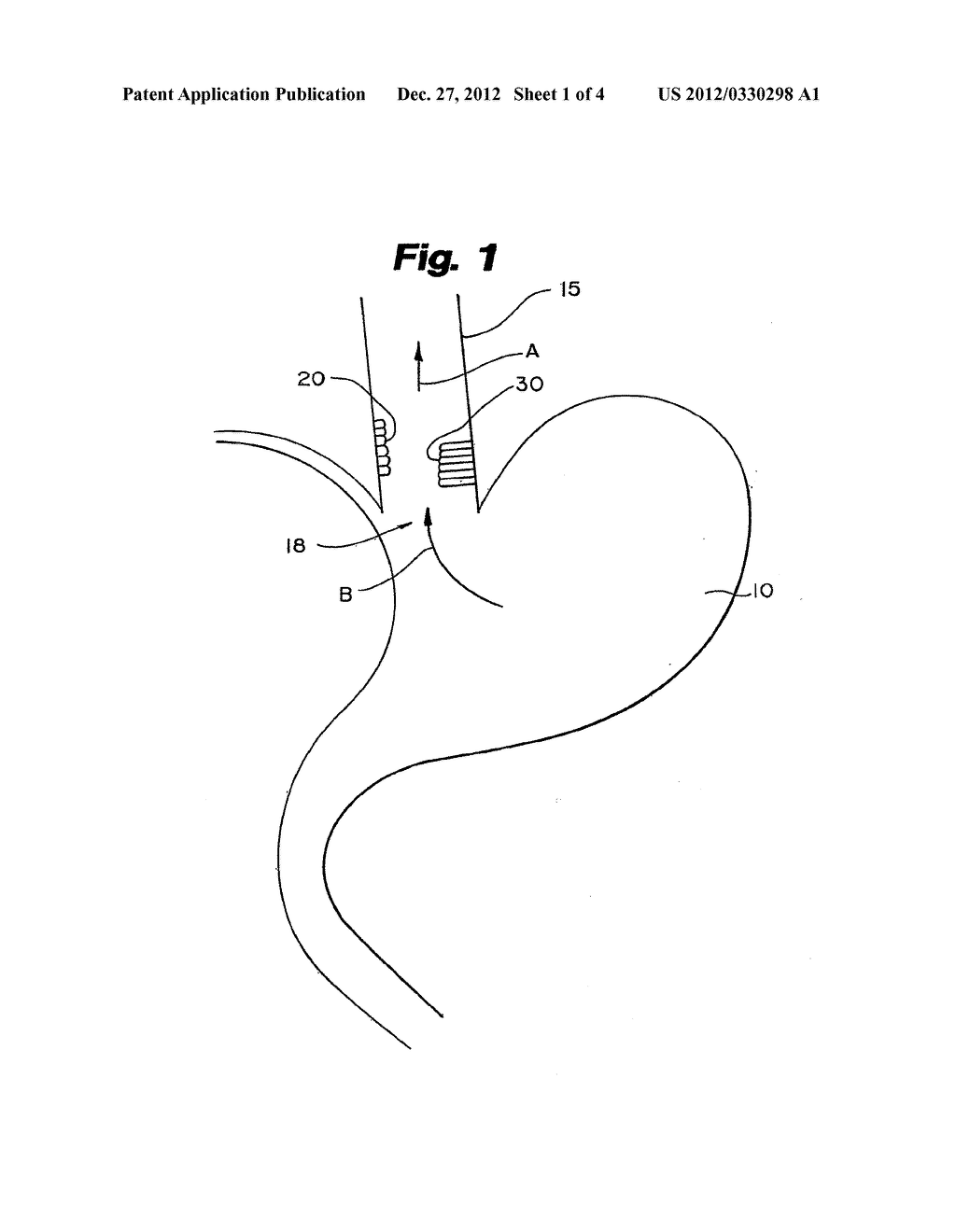 SYSTEM AND METHOD OF TREATING ABNORMAL TISSUE IN THE HUMAN ESOPHAGUS - diagram, schematic, and image 02