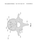 INTRAOSSEOUS NERVE DENERVATION METHODS diagram and image