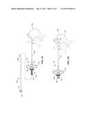 INTRAOSSEOUS NERVE DENERVATION METHODS diagram and image