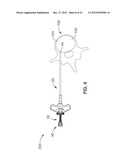 INTRAOSSEOUS NERVE DENERVATION METHODS diagram and image