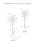 INTRAOSSEOUS NERVE DENERVATION METHODS diagram and image