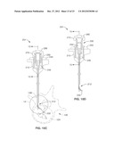 INTRAOSSEOUS NERVE DENERVATION METHODS diagram and image