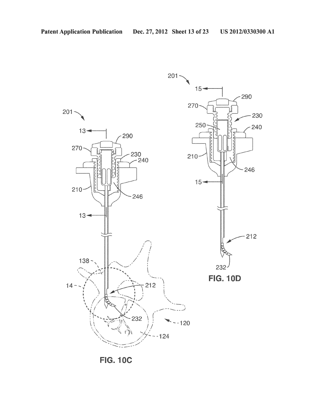 INTRAOSSEOUS NERVE DENERVATION METHODS - diagram, schematic, and image 14