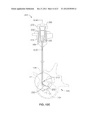 INTRAOSSEOUS NERVE DENERVATION METHODS diagram and image