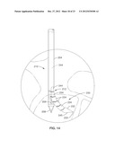 INTRAOSSEOUS NERVE DENERVATION METHODS diagram and image