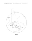 INTRAOSSEOUS NERVE DENERVATION METHODS diagram and image