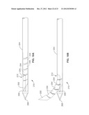 INTRAOSSEOUS NERVE DENERVATION METHODS diagram and image