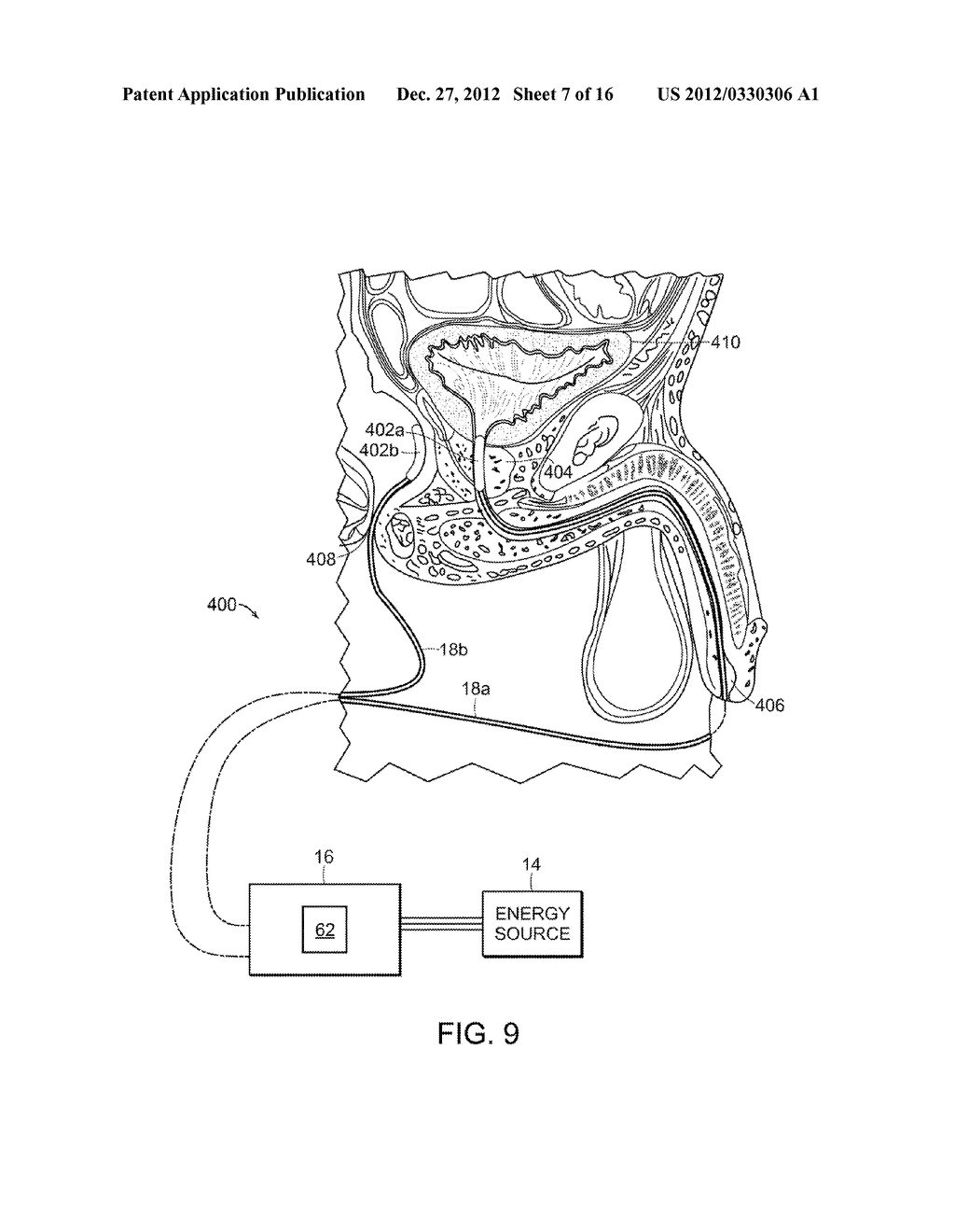 ELECTRICAL ABLATION DEVICES - diagram, schematic, and image 08