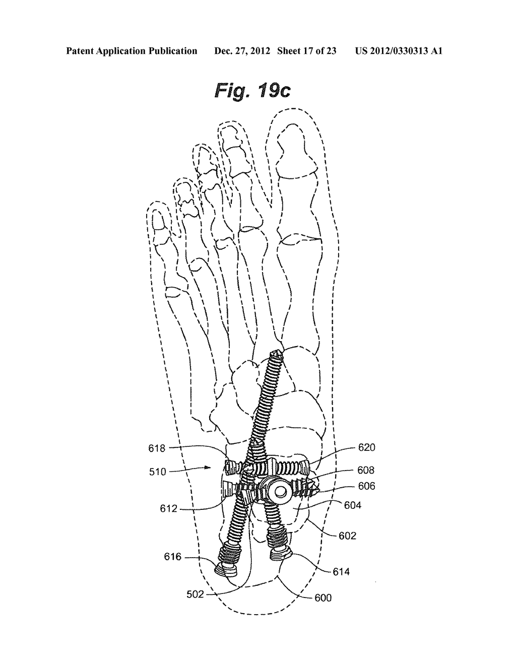 Intramedullary nail technology - diagram, schematic, and image 18