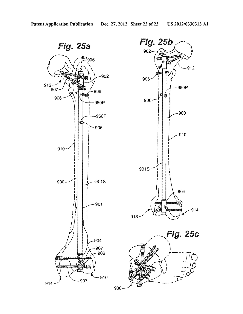 Intramedullary nail technology - diagram, schematic, and image 23