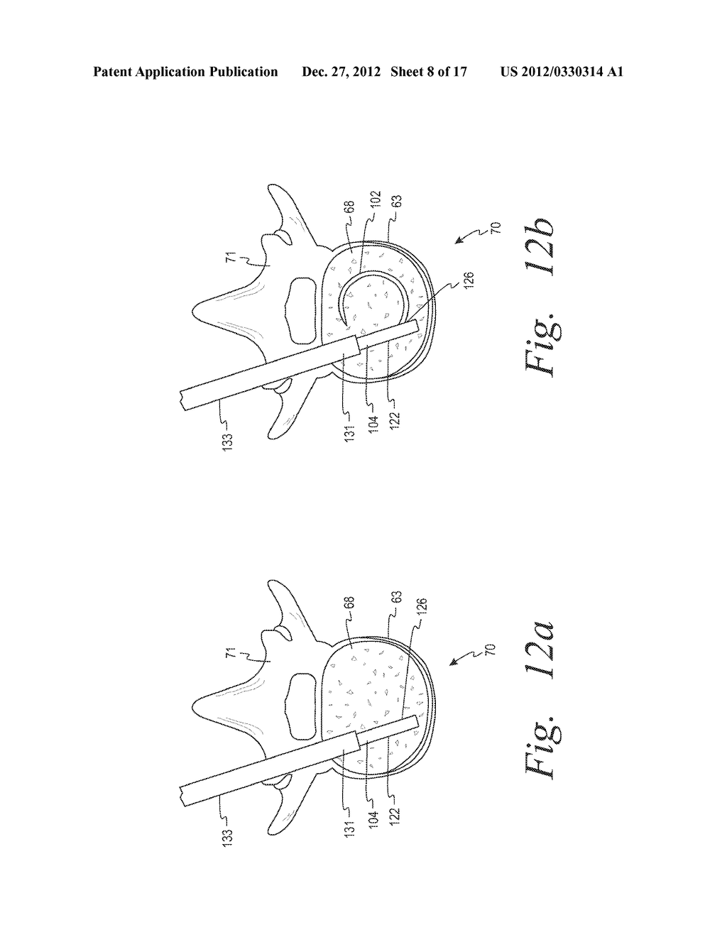 Devices And Methods For Treating Bone Tissue - diagram, schematic, and image 09