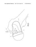 CUTTING GUIDE FOR REMOVAL OF CAM LESION diagram and image