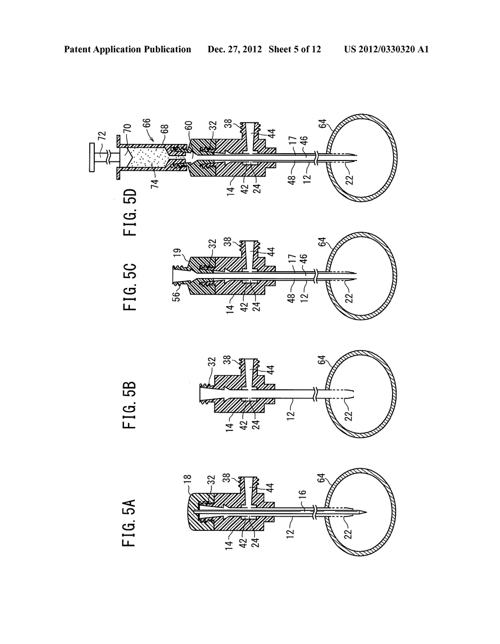 BONE CEMENT INJECTION PUNCTURE NEEDLE - diagram, schematic, and image 06