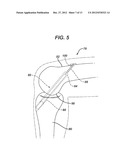 ACL RECONSTRUCTION TUNNEL GAUGE AND METHOD diagram and image