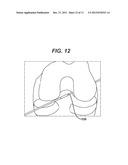 ACL RECONSTRUCTION TUNNEL GAUGE AND METHOD diagram and image