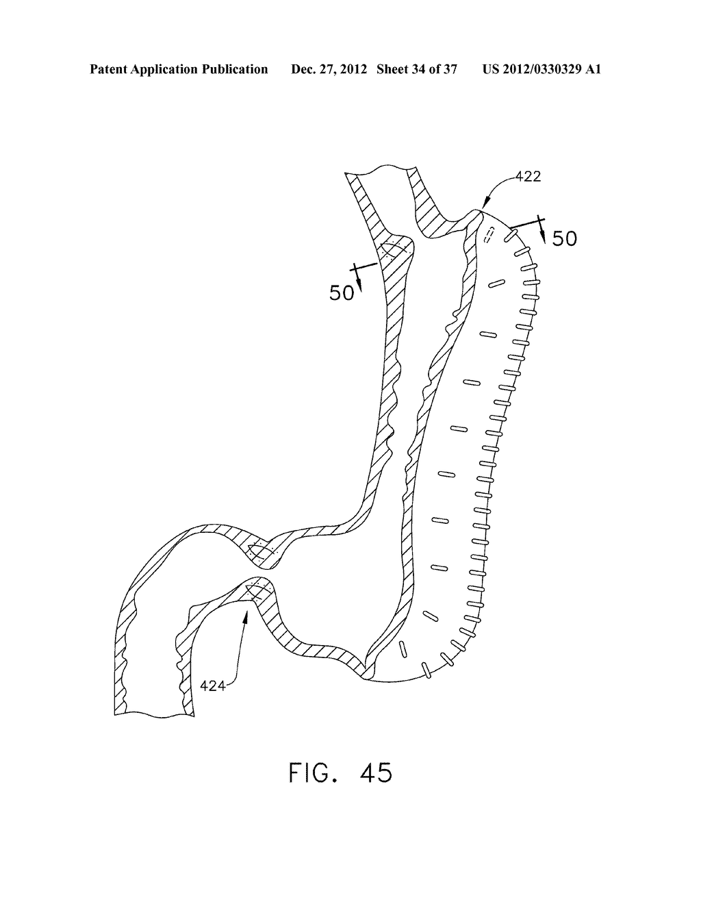 METHODS OF FORMING A LAPAROSCOPIC GREATER CURVATURE PLICATION USING A     SURGICAL STAPLER - diagram, schematic, and image 35