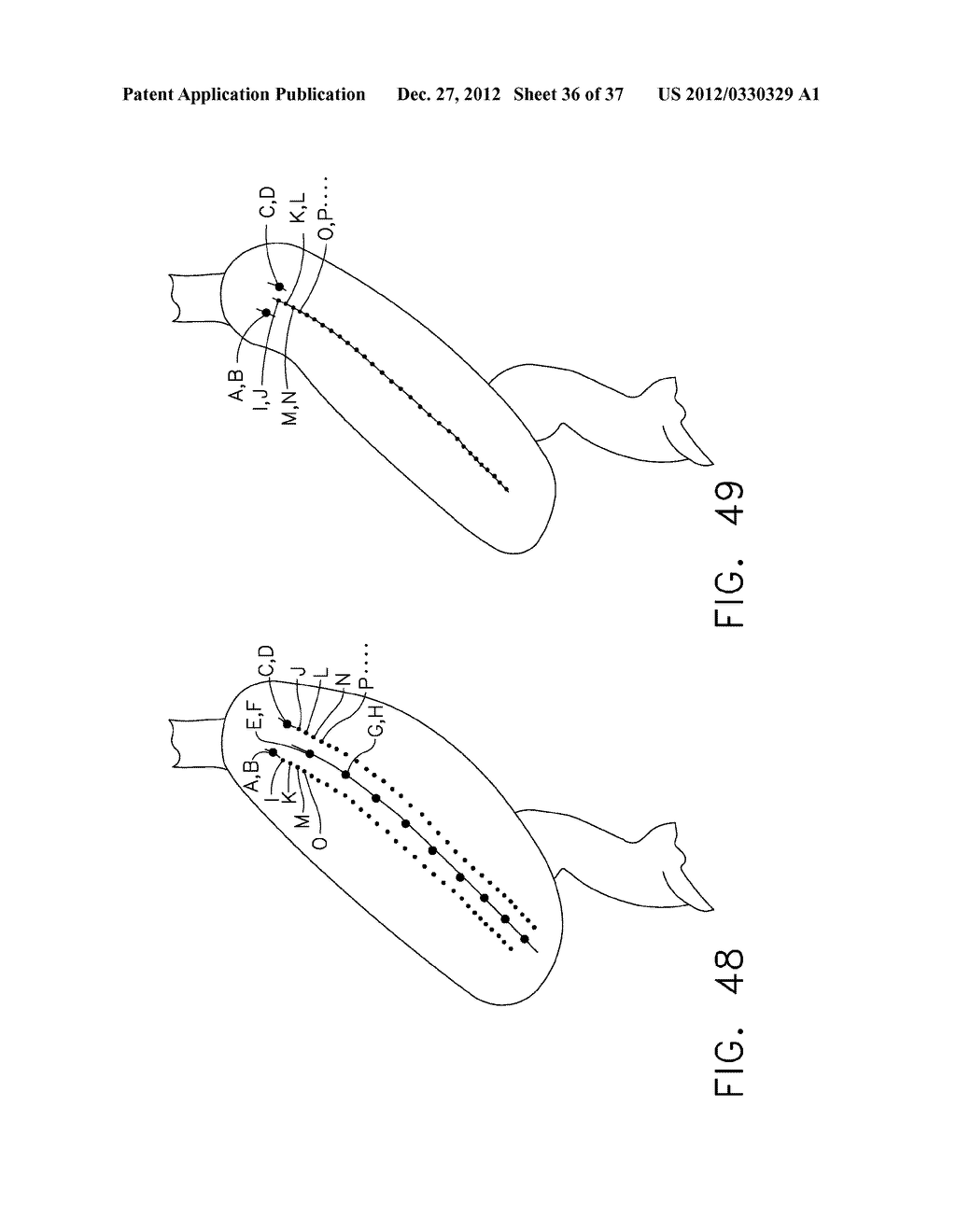 METHODS OF FORMING A LAPAROSCOPIC GREATER CURVATURE PLICATION USING A     SURGICAL STAPLER - diagram, schematic, and image 37
