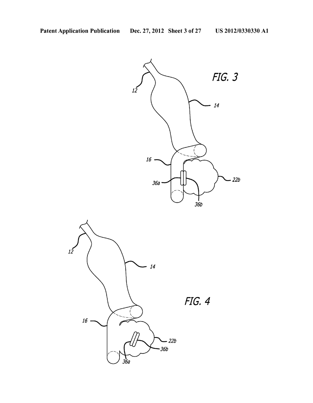 Incisionless Gastric Bypass Method And Devices - diagram, schematic, and image 04