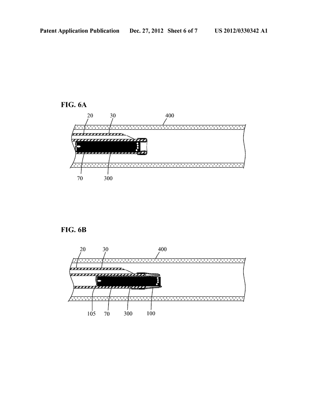 SYSTEMS AND DEVICES FOR INTRALUMENAL IMPLANTATION - diagram, schematic, and image 07