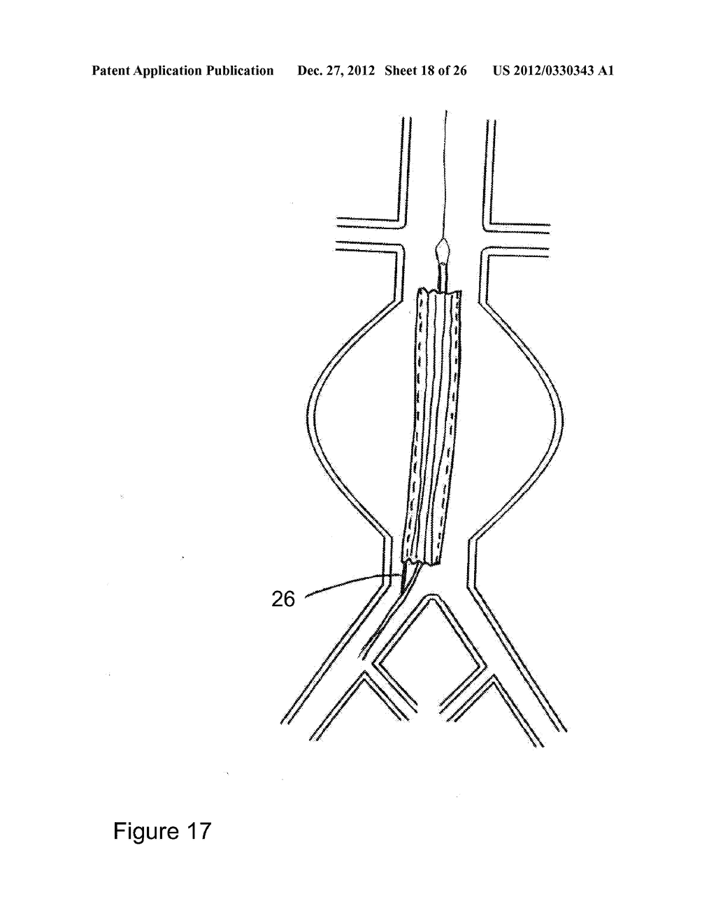 DEVICES AND METHODS FOR TREATMENT OF VASCULAR ANEURYSMS - diagram, schematic, and image 19