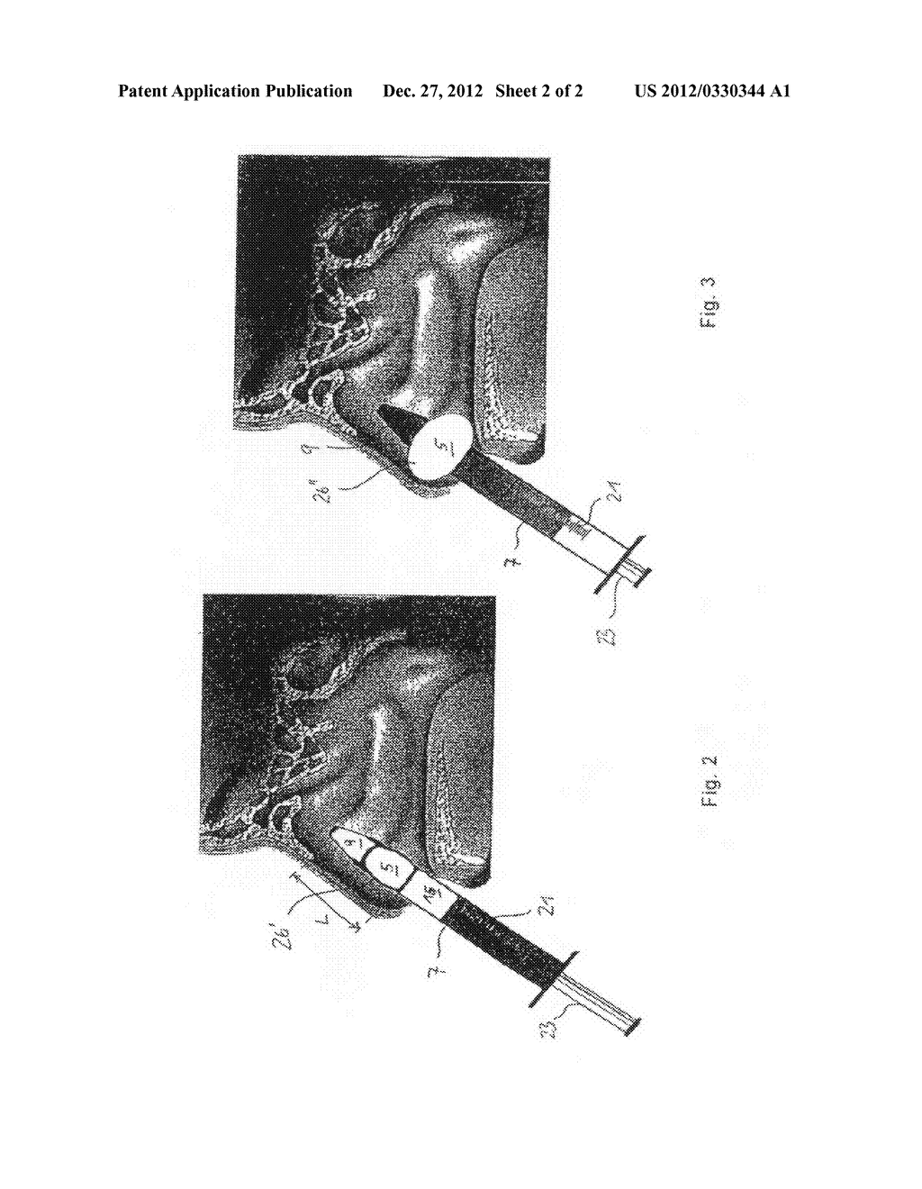DEVICE AND METHOD FOR CONTROLLING NASAL EXUDATION - diagram, schematic, and image 03