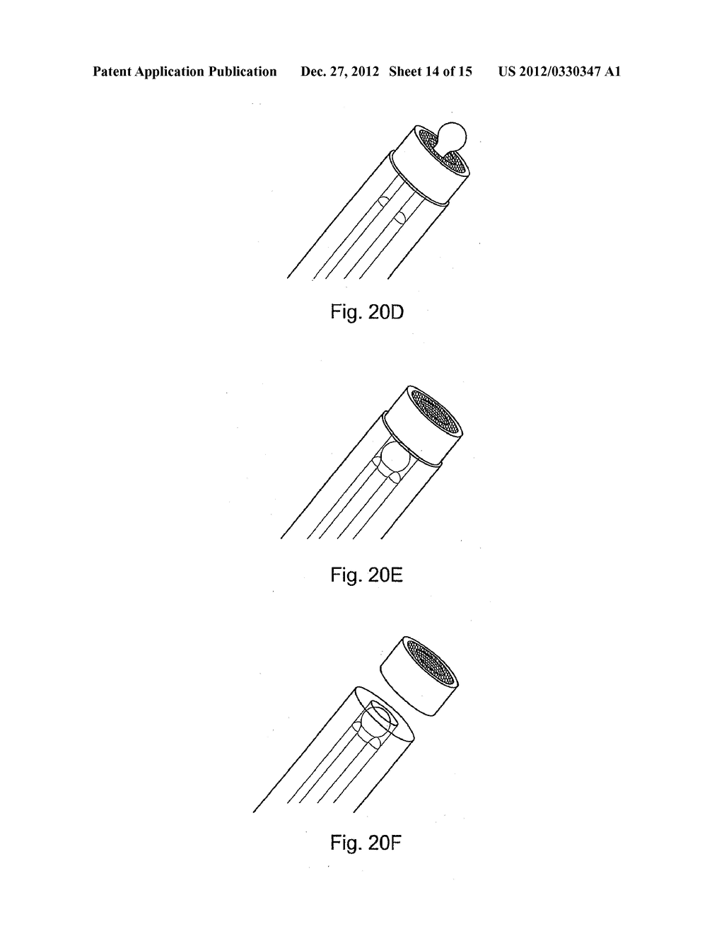 Multiple Layer Filamentary Devices for Treatment of Vascular Defects - diagram, schematic, and image 15