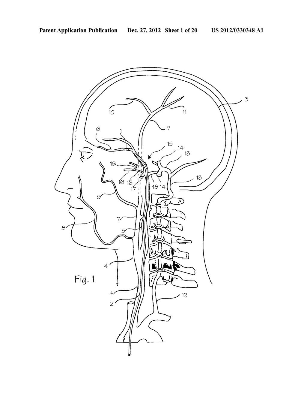 Embolic Implant and Method of Use - diagram, schematic, and image 02