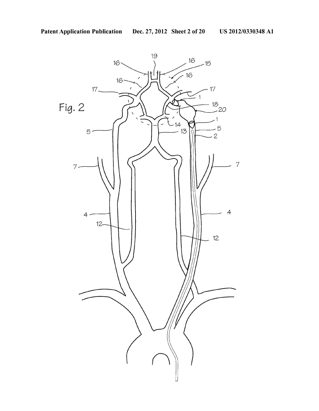 Embolic Implant and Method of Use - diagram, schematic, and image 03